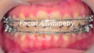 Facial asymmetry [upl. by Pauli]