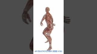 팔꿈치 관절  청소년 박리성 골연골염의 이해 Elbow Joints Understanding Osteochondritis Dissecans in Adolescents [upl. by Aggarwal865]