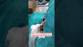 Microwave ablation liver tumor for metastatic liver lesions liverablation metastaticlivertumor [upl. by Secnarfyram936]