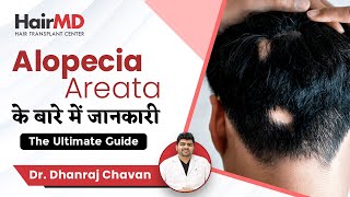 Ultimate Alopecia Areata Guide  Alopecia Areata के बारे में जानकारी  HairMD Pune [upl. by Ellekram]