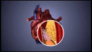 Atherosclerosis  3D Animation  ABP © [upl. by Nylirac]