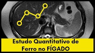 Estudo Quantitativo de Ferro Hepático na Ressonância Magnética [upl. by Nyletac]