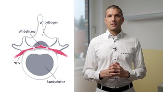 Behandlungsmöglichkeiten der Spinalkanalstenose [upl. by Ikkaj]