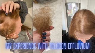 My Experience with Telogen Effluvium [upl. by Seravat]