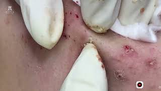 Big Cystic Acne Blackheads Extraction Blackheads amp Milia Whiteheads Removal Pimple Popping [upl. by Delisle]