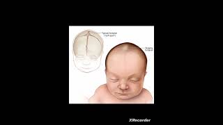 Clinical significance of fontanel [upl. by Ellicul580]