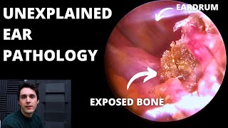 Benign Necrotising Otitis Externa 3 cases [upl. by Heeley302]