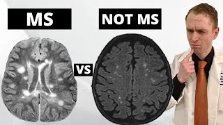 MS MRI Lesions VS quotBenignquot White Matter Lesions Explained by Neurologist [upl. by Gnad]