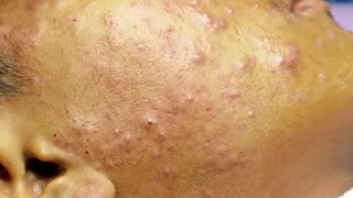 Extraction boutons et acné kystique cystic acne sur le visage [upl. by Airan189]