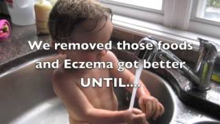 Eczema Asthma Food Allergies Want to know how to Improve Immune system [upl. by Nwaf]