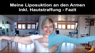 Meine Liposuktion an den Armen inkl chirurgischer Hautstraffung  Fazit [upl. by Forsyth]