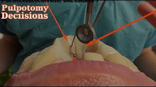 Indications for Coronal vs Partial Pulpotomy Irreversible Pulpitis [upl. by Ardnasxela579]