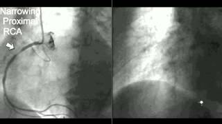 Coronary CT Angiography Cath [upl. by Tana]