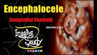 Encephalocele  Meningoencephalocele  Microcephaly  Ultrasound  Anomaly  Case 277 [upl. by Ashok]