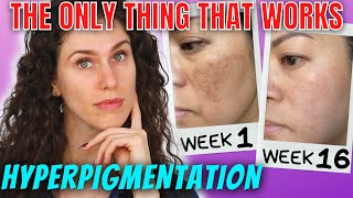 The ONLY Ingredients That Stop Hyperpigmentation And Reverse It [upl. by Illac]