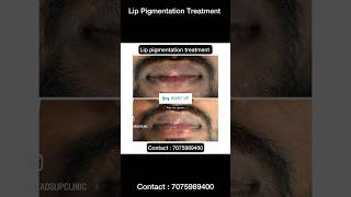 Laser lip pigmentation treatment ✨ [upl. by Yggam]