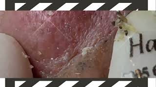 BEST BLACKHEAD amp CYST POPPING [upl. by Rednirah]