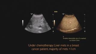 malignant focal liver lesions [upl. by Springer]