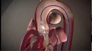 Edwards SAPIEN Transcatheter Heart Valve with the RetroFlex 3 Transfermoral System TAVR [upl. by Ardied267]