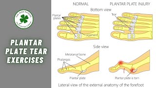 Plantar Plate Tear Exercises  6 of the Best Exercises for a Plantar Plate Tear [upl. by Georas]