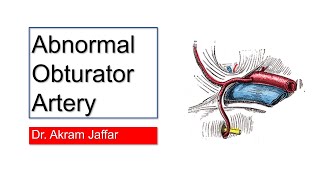 Abnormal aberrant obturator artery corona mortis [upl. by Araik]