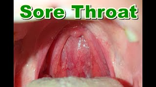 Normal vs Sore Throat  Pharyngitis [upl. by Brenner793]