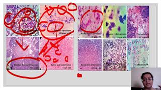 Pitfalls and troubleshoots in salivary gland lesion cytology malignant [upl. by Harberd]