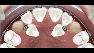 Orthodontic case report for palatally impacted canines traction [upl. by Ballman199]