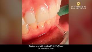 Gingivectomy with LiteTouch™ ErYAG laser [upl. by Nayrb]