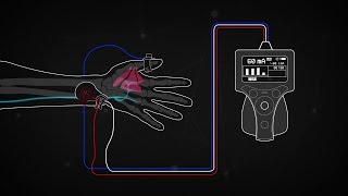 Train of Four Monitoring using the Ulnar Nerve [upl. by Adarbil]