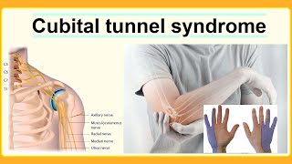 cubital tunnel syndrome [upl. by Atteynad]