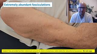 Needle EMG fasciculations [upl. by Blackington640]