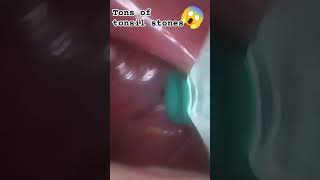 TONS of tonsil stones in that spot 😱 tonsilstones tonsils tonsilolitos gross tonsilloliths [upl. by Luci]