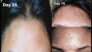 How to clear Tiny bumps on forehead small pimples small bumps on face Acne Prone Skincare Routine [upl. by Efram]