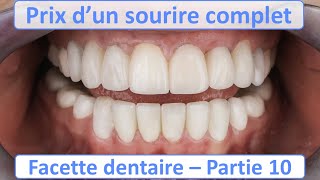 Prix Facette dentaire pour un sourire complet  Guide complet Facette dentaire  partie 10 [upl. by Adrien54]