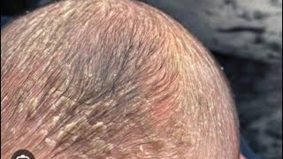 How to get rid of cradle cap in babieswhat is cradle cap [upl. by Michelina]