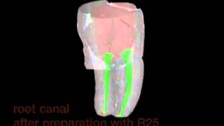 VDW Dental · MicroCTScan of a lower molar clinical video [upl. by La Verne]