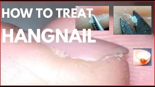 How to treat hangnails Agnail treatment [upl. by Vary]