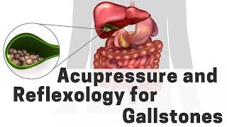 Acupressure and Reflexology for Gallstones  Massage Monday 385 [upl. by Anaile]