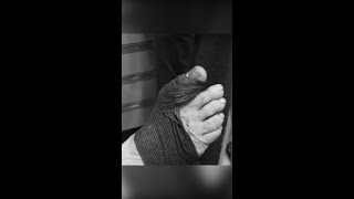 Arthrtitic bump removed in under 15 minutes arthriticbump podiatrist [upl. by Edin]