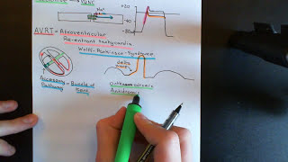 Cardiac Arrhythmias Part 7 [upl. by Stelmach86]