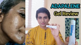 adapalene gel review telugu  adaferin gel for acne commedones and acne marks How to use adapalene [upl. by Sukramal]