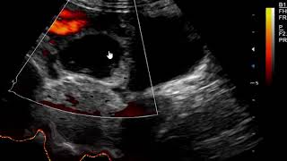 Hemorrhagic Corpus luteum cyst on Ultrasound scan [upl. by Culver]