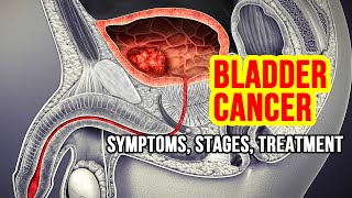 Bladder Cancer Explained Symptoms Risk Factors and Treatment Options [upl. by Airtina]