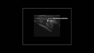 Subcoracoid anteromedial impingement of the subscapularis tendon on dynamic shoulder ultrasound [upl. by Araes]