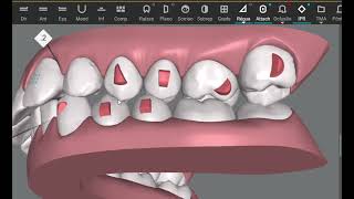 Invisalign clincheck simulation Cross bite correction Is it possible [upl. by Yzzik]