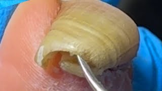 Extremely long ingrown toenailsThe patient has not had a pedicure for 4 months【Xue Yidao】 [upl. by Thatch]