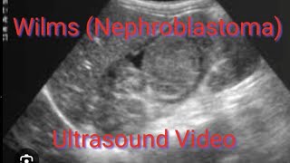 NEPHROBLASTOMA Wilms Tumor ultrasound appearence on video demonstration [upl. by Tabib]