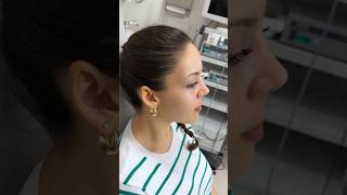 Rhinoplasty Result 👃🏻 Dr Ahmet Dilber 🪄 rhinoplastyturkey plasticsurgery [upl. by Nannek]