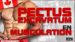 LE PECTUS EXCAVATUM EN MUSCULATION [upl. by Hackney]